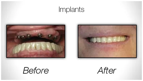 Before And After Photo Showing The Results Of All-On-6 Dental Implants