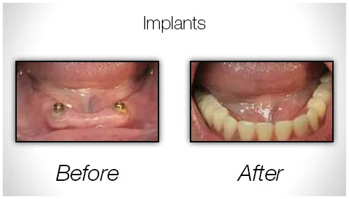 Before And After Photo Showing The Results Of Dental Implants