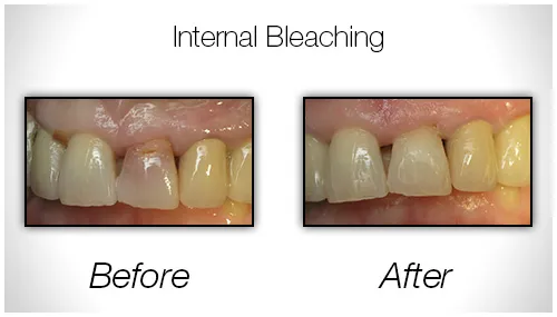 Before And After Photo Showing The Results Of Internal Bleaching