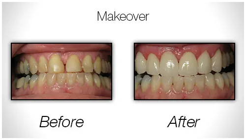 Before And After Photo Showing A Restored Smile