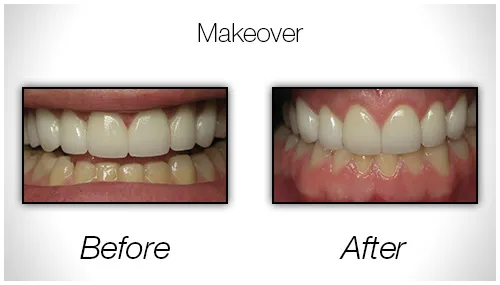 Before And After Photo Showing The Results Of A Smile Makeover