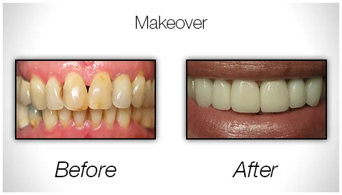 Before And After Photo Showing The Results Of A Smile Makeover Procedure