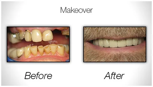Before And After Photo Showing Repaired Broken Teeth