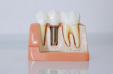 Dental Implant Cutaway